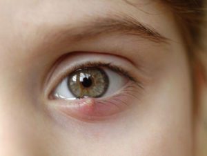 Eye Stye - Hordeulum