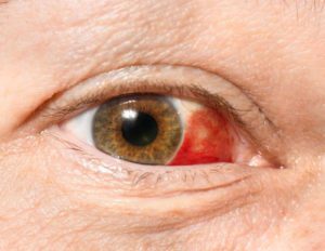 Subconjunctival Hemorrhage